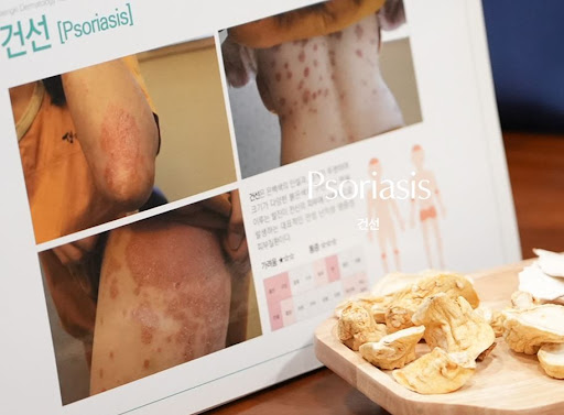 생기한의원 건선 초기 붉은 반점 관찰 시 살펴볼 내용