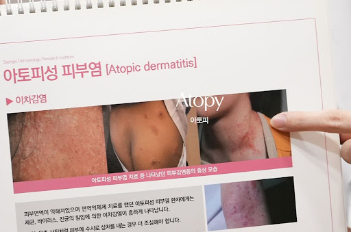생기한의원 아토피 페이지에서 보는 접촉성피부염과의 차이